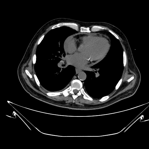 Aortic arch aneurysm (Radiopaedia 84109-99365 Axial non-contrast 163).jpg