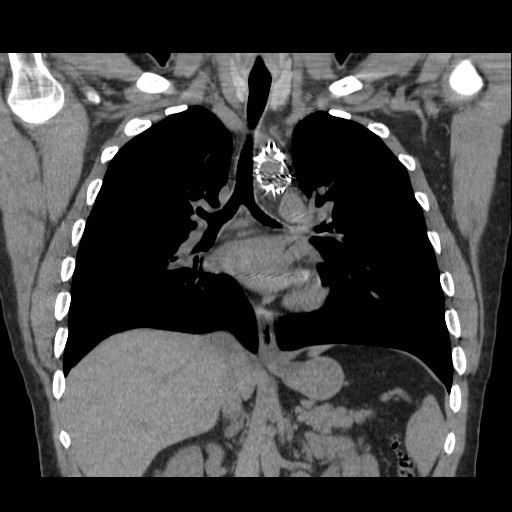 File:Aortic arch stent (Radiopaedia 30030-30595 Coronal non-contrast 12).jpg