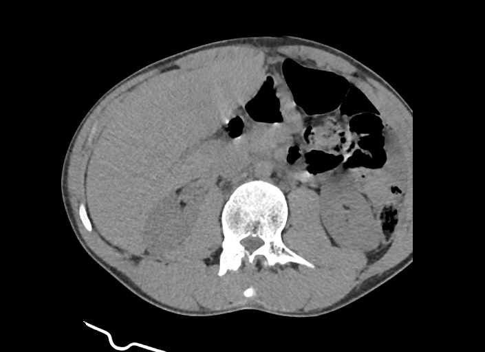 File:Aortic coarctation with aneurysm (Radiopaedia 74818-85828 A 6).jpg