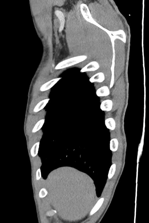 Aortic coarctation with aneurysm (Radiopaedia 74818-85828 B 24).jpg