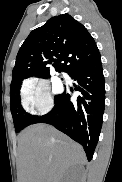 Aortic coarctation with aneurysm (Radiopaedia 74818-85828 B 53).jpg