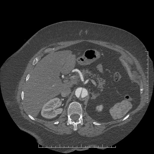 Aortic dissection- Stanford A (Radiopaedia 35729-37268 B 47).jpg