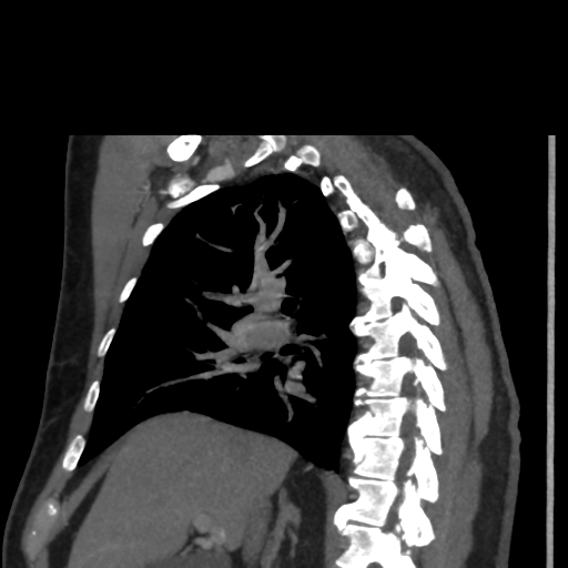 File:Aortic dissection- Stanford A (Radiopaedia 37759-39664 D 4).png