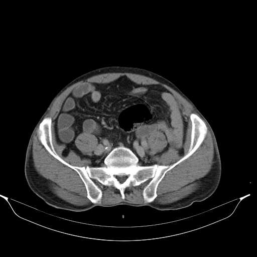 File:Aortic dissection- Stanford type A (Radiopaedia 22085-22085 Axial C+ delayed 39).jpg