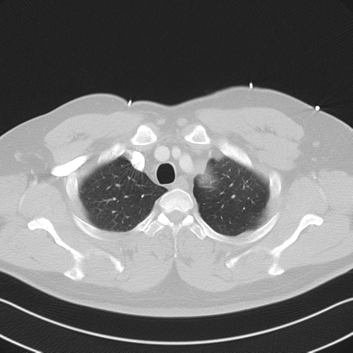 File:Aortic dissection (Radiopaedia 50763-56234 Axial lung window 16).png
