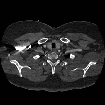 Aortic dissection (Radiopaedia 57969-64959 A 34).jpg
