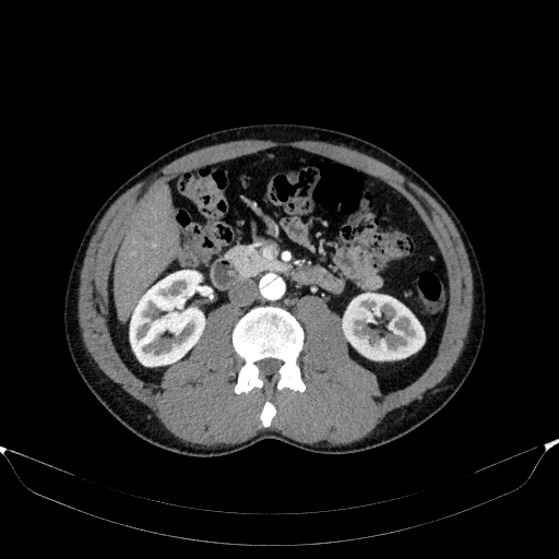 File:Aortic dissection - Stanford type A (Radiopaedia 83418-98500 A 77).jpg
