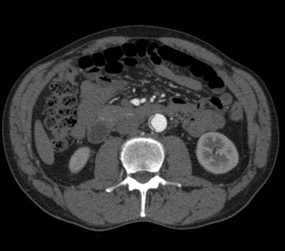Aortic dissection - Stanford type B (Radiopaedia 73648-84437 A 159).jpg