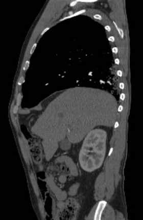 File:Aortic dissection - Stanford type B (Radiopaedia 73648-84437 C 115).jpg