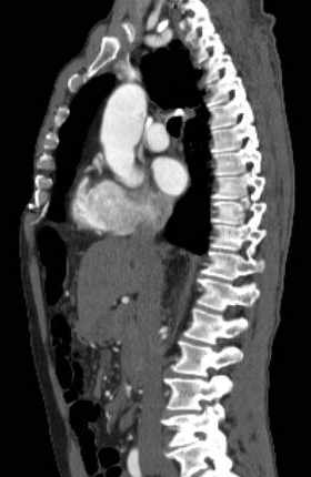 File:Aortic dissection - Stanford type B (Radiopaedia 73648-84437 C 86).jpg