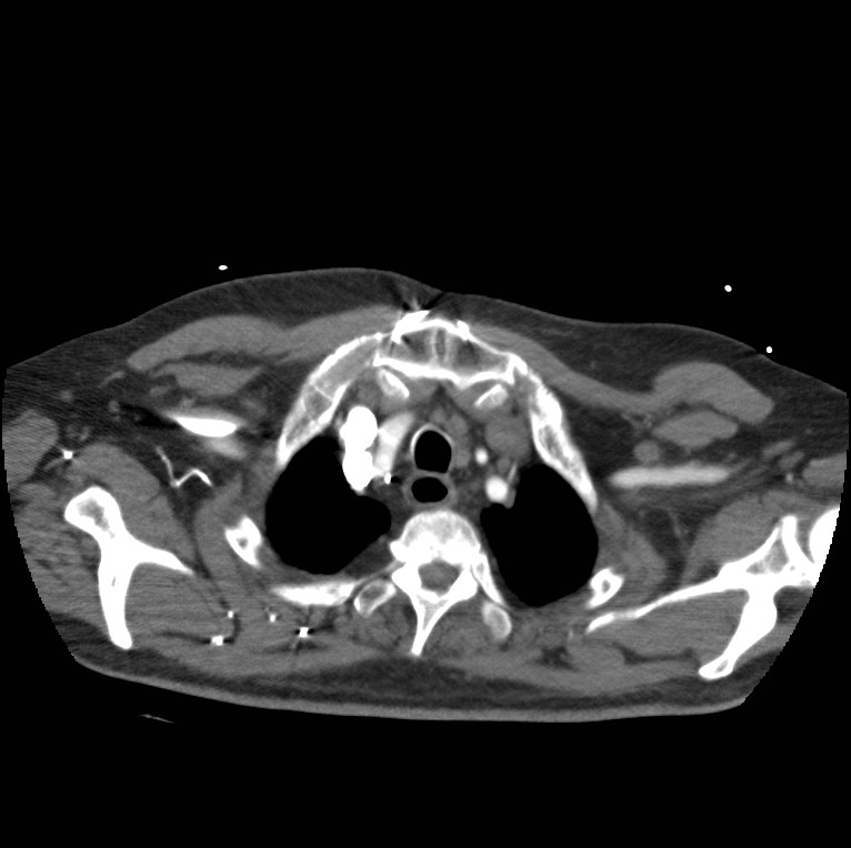 Aortic dissection with rupture into pericardium (Radiopaedia 12384-12647 A 9).jpg