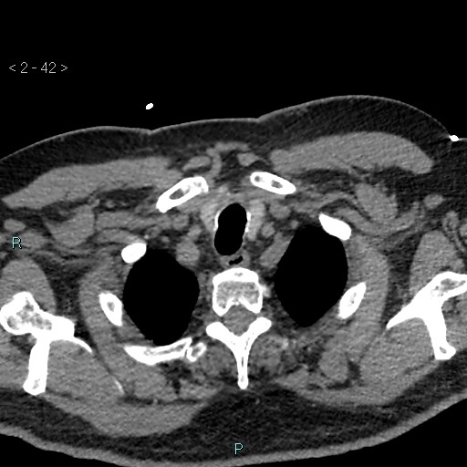 Aortic intramural hematoma (Radiopaedia 48463-53380 Axial non-contrast 18).jpg
