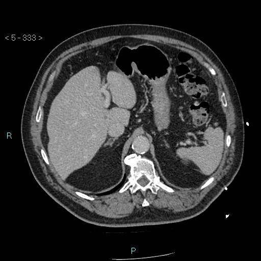 Aortic intramural hematoma (Radiopaedia 48463-53380 C 149).jpg