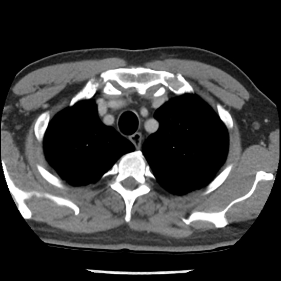 Aortic intramural hematoma (type B) (Radiopaedia 79323-92387 Axial C+ delayed 7).jpg