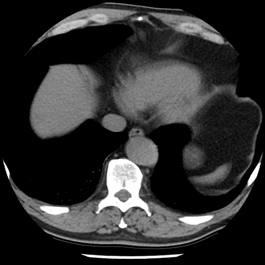Aortic intramural hematoma (type B) (Radiopaedia 79323-92387 Axial non-contrast 43).jpg