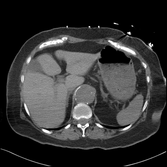 Aortic intramural hematoma with dissection and intramural blood pool (Radiopaedia 77373-89491 Axial non-contrast 95).jpg