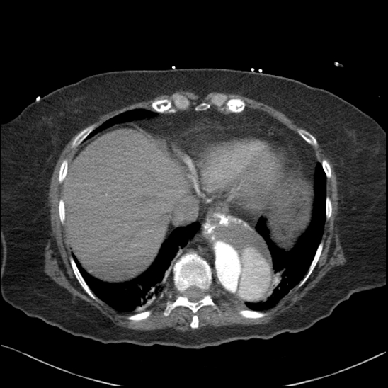 Aortic intramural hematoma with dissection and intramural blood pool (Radiopaedia 77373-89491 B 88).jpg