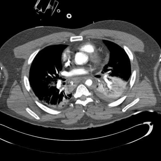 Aortic transection, diaphragmatic rupture and hemoperitoneum in a complex multitrauma patient (Radiopaedia 31701-32622 A 45).jpg