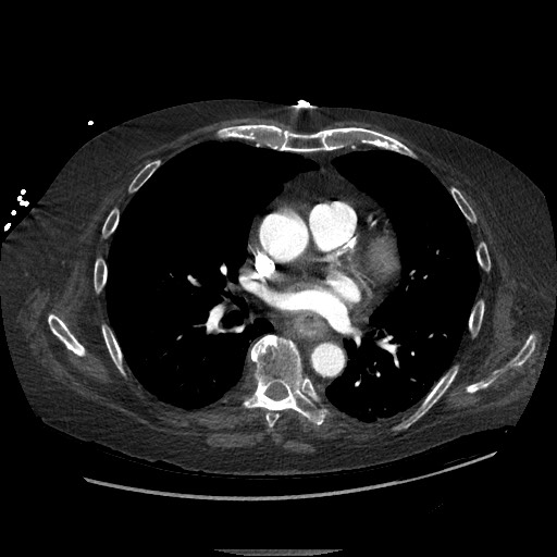File:Aortoesophageal fistula with endovascular repair (Radiopaedia 73781-84592 Axial C+ CTPA 82).jpg