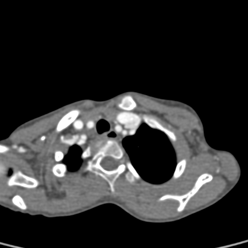File:Aortopulmonary window, interrupted aortic arch and large PDA giving the descending aorta (Radiopaedia 35573-37074 B 10).jpg