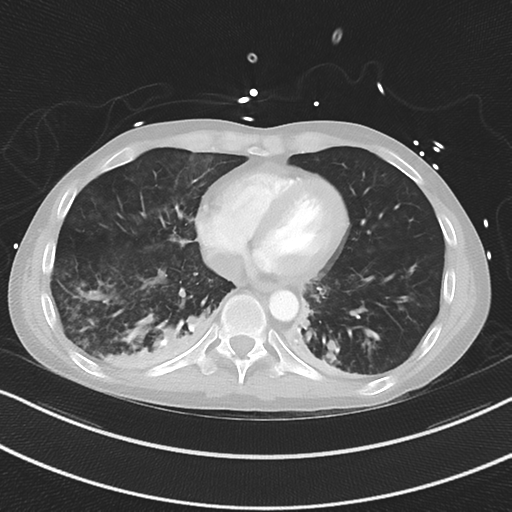 Apical bullous disease in a heavy smoker (Radiopaedia 33067-34092 Axial lung window 44).png