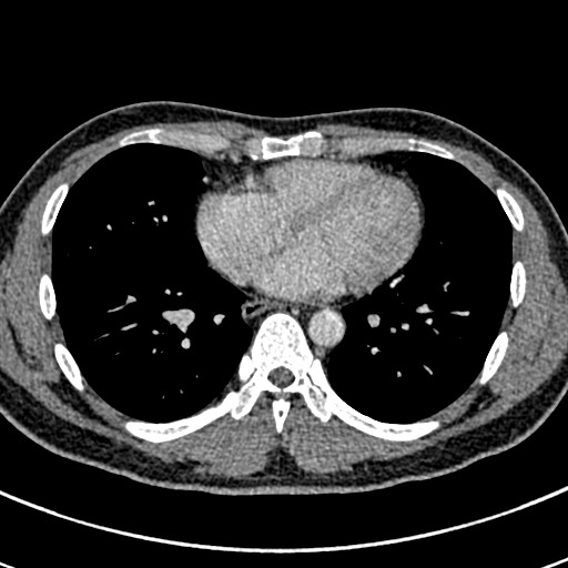Apical lung mass mimic - neurogenic tumor (Radiopaedia 59918-67521 A 52).jpg