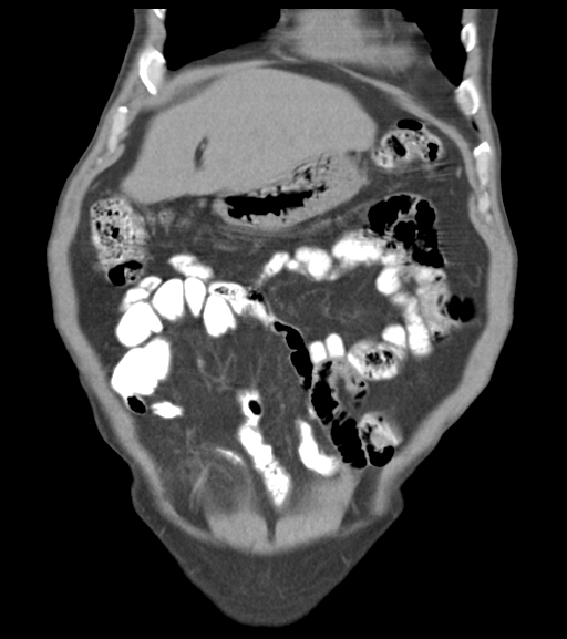 File:Appendiceal abscesses (Radiopaedia 50999-56542 Coronal non-contrast 17).png