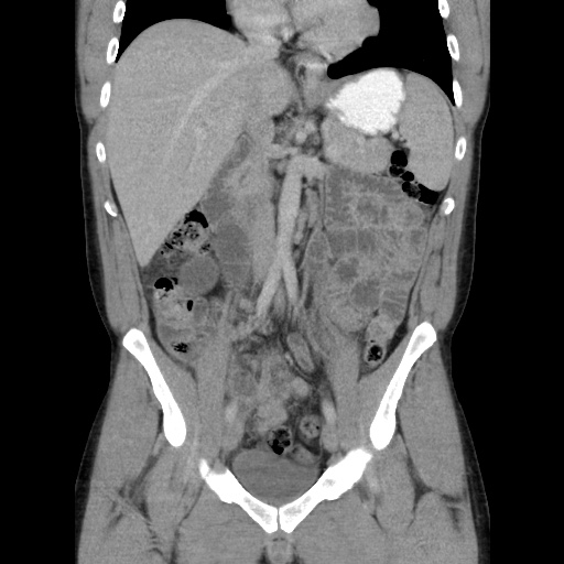 Appendicitis complicated by post-operative collection (Radiopaedia 35595-37114 B 27).jpg