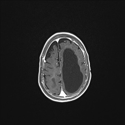 Aqueductal stenosis (Radiopaedia 73974-84802 Axial T1 C+ 125).jpg