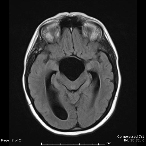 File:Arachnoid cyst distorting the third ventricle (Radiopaedia 6111-7583 Coronal FLAIR 1).jpg