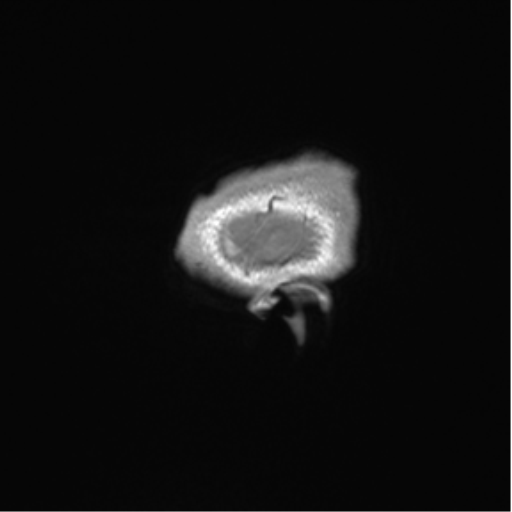 Arachnoid cyst with subdural hematoma (Radiopaedia 85892-101743 Sagittal T1 4).png