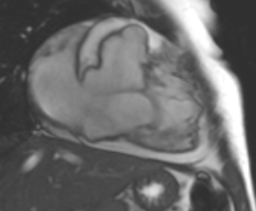Arrhythmogenic right ventricular cardiomyopathy (Radiopaedia 69431-79307 2ch cine 45).jpg