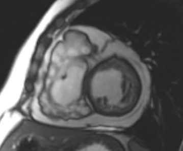File:Arrhythmogenic right ventricular cardiomyopathy (Radiopaedia 69431-79307 Short axis cine 123).jpg