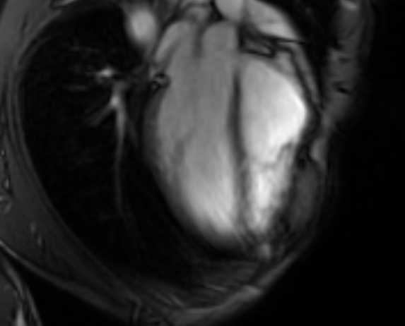 Arrhythmogenic right ventricular cardiomyopathy (Radiopaedia 69564-79464 4ch cine 35).jpg