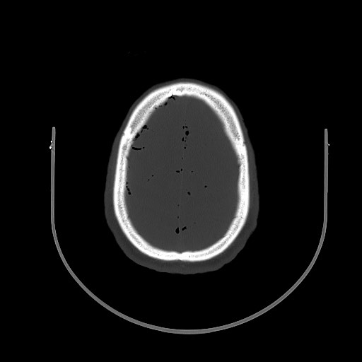 Arrow injury to the brain (Radiopaedia 72101-82607 Axial bone window 86).jpg