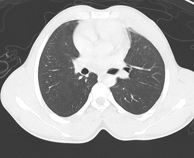Arrow injury to the chest (Radiopaedia 75223-86321 Axial lung window 34).jpg