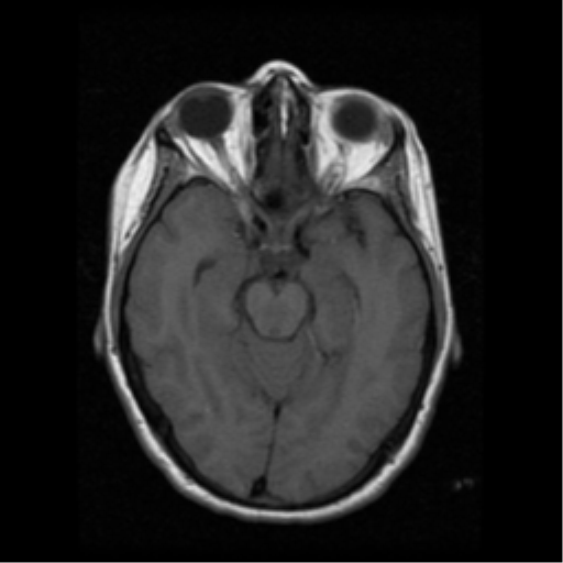 File:Arteriovenous malformation (cerebral) (Radiopaedia 40070-42580 Axial T1 8).png