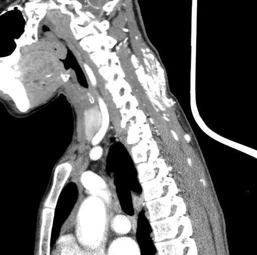 Arteriovenous malformation of the neck (Radiopaedia 53935-60062 C 55).jpg