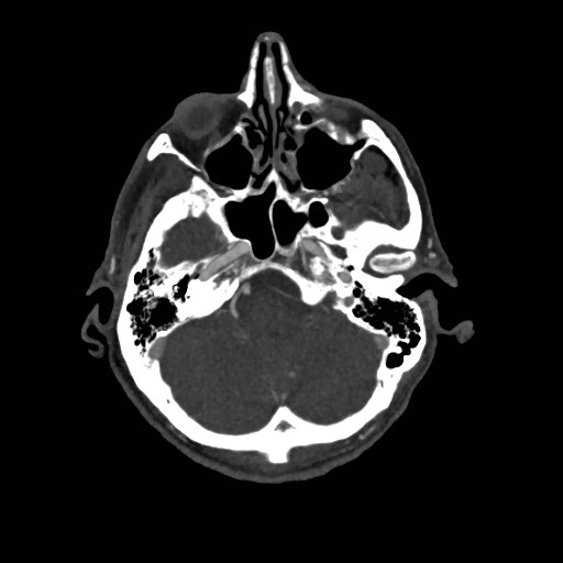 Artery of Percheron infarct (Radiopaedia 48088-52894 A 114).jpg