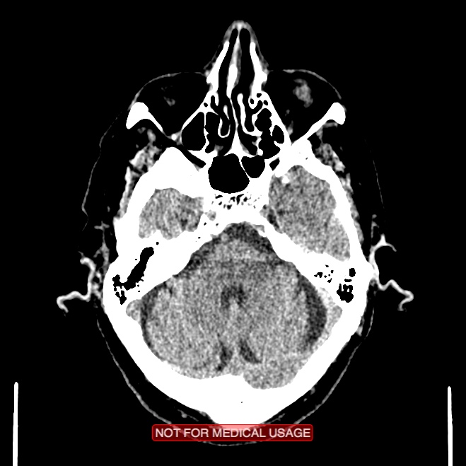 Artery of Percheron infarction (Radiopaedia 28679-28967 Axial non-contrast 31).jpg
