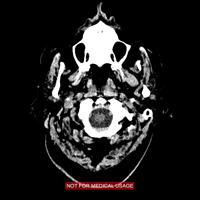 Artery of Percheron infarction (Radiopaedia 28679-28967 Axial non-contrast 4).jpg