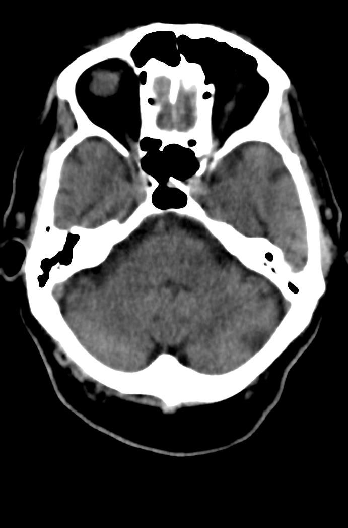 Artery of Percheron infarction (Radiopaedia 80613-94202 Axial non-contrast 57).jpg