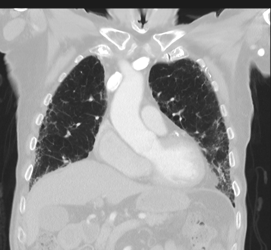 Asbestosis (Radiopaedia 56192-62864 Coronal lung window 18).png