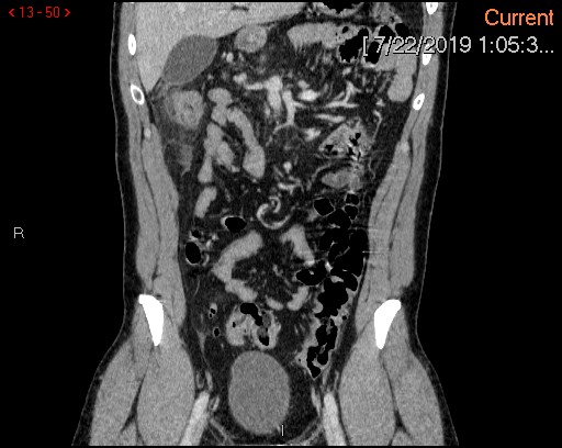 File:Ascending colonic diverticulum mimicking acute appendicitis (Radiopaedia 69943-80198 B 50).jpg