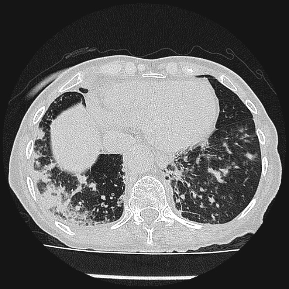 Aspergilloma (Radiopaedia 24458-24763 Axial lung window 54).jpg