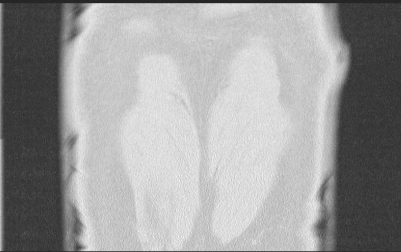 Aspirated tooth (Radiopaedia 28584-28844 Axial lung window 95).jpg