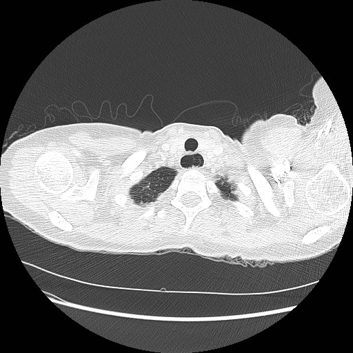 Aspiration pneumonia secondary to laparoscopic banding (Radiopaedia 18345-18183 lung window 2).jpg
