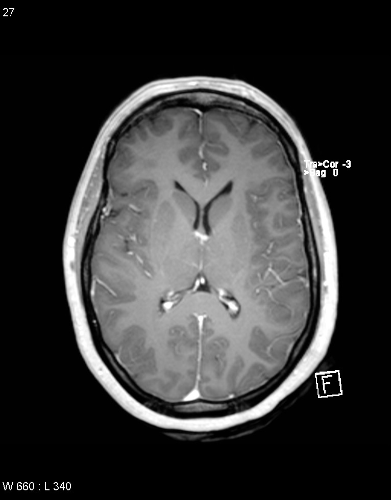 Astroblastoma (Radiopaedia 39792-42218 Axial T1 C+ 26).jpg