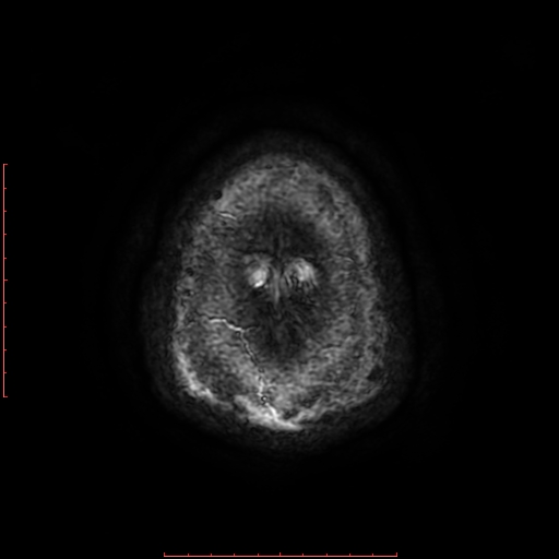 Astrocytoma NOS - cystic (Radiopaedia 59089-66384 Axial SWI 72).jpg