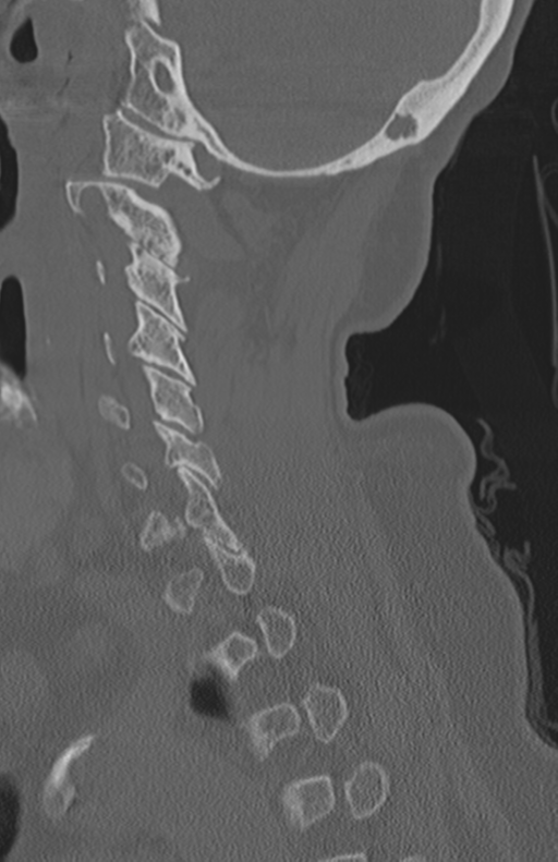 Atlanto-axial subluxation (Radiopaedia 36610-38176 Sagittal bone window 30).png